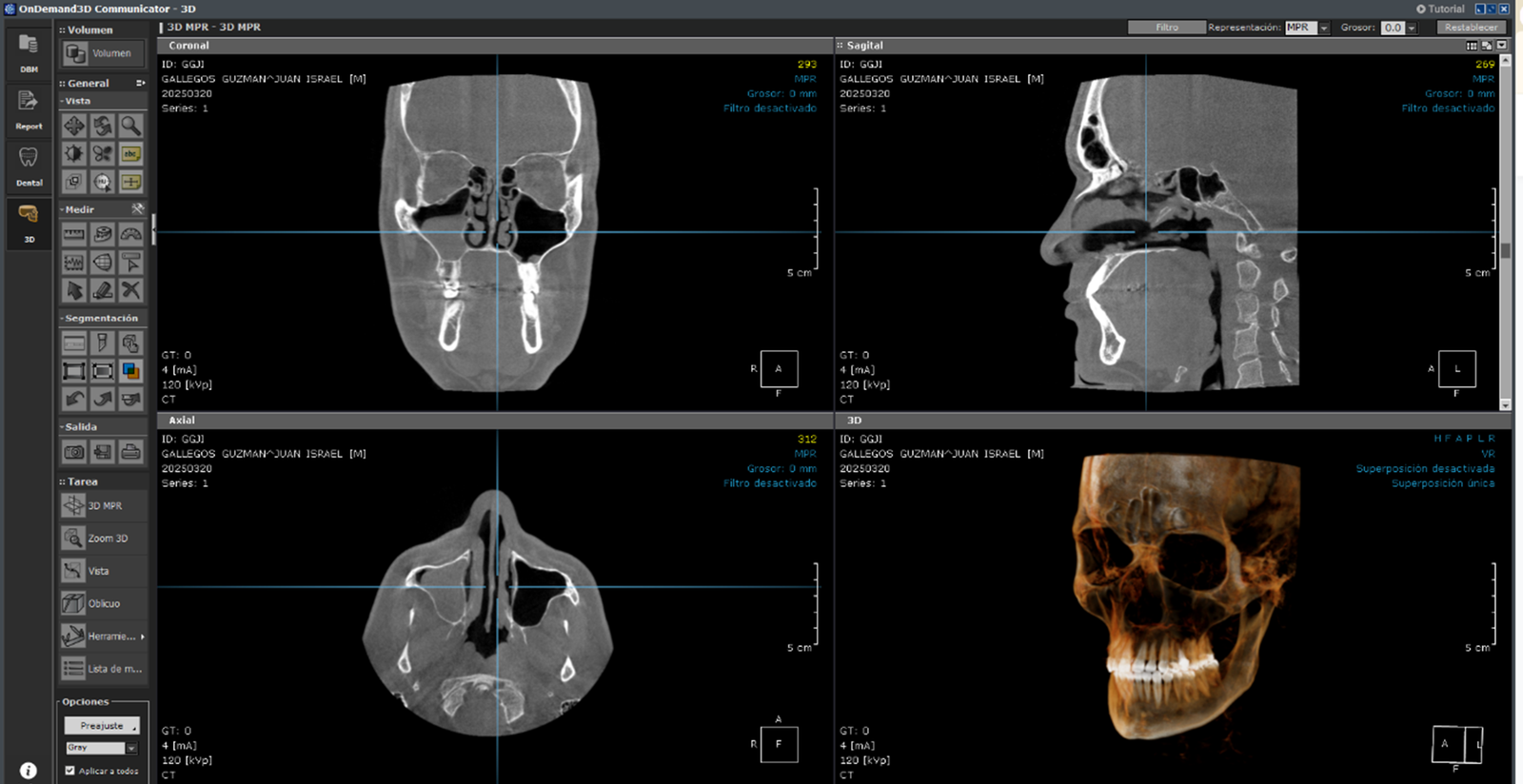 Reconstrucción 3D y Cortes